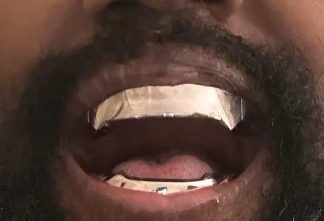 Kanye West, protesi al titanio al posto dei denti