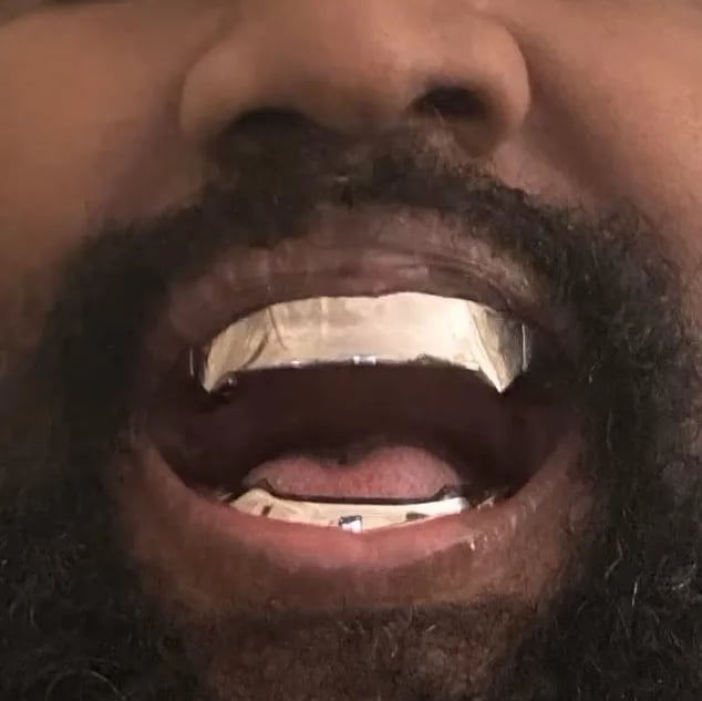 Kanye West, protesi al titanio al posto dei denti